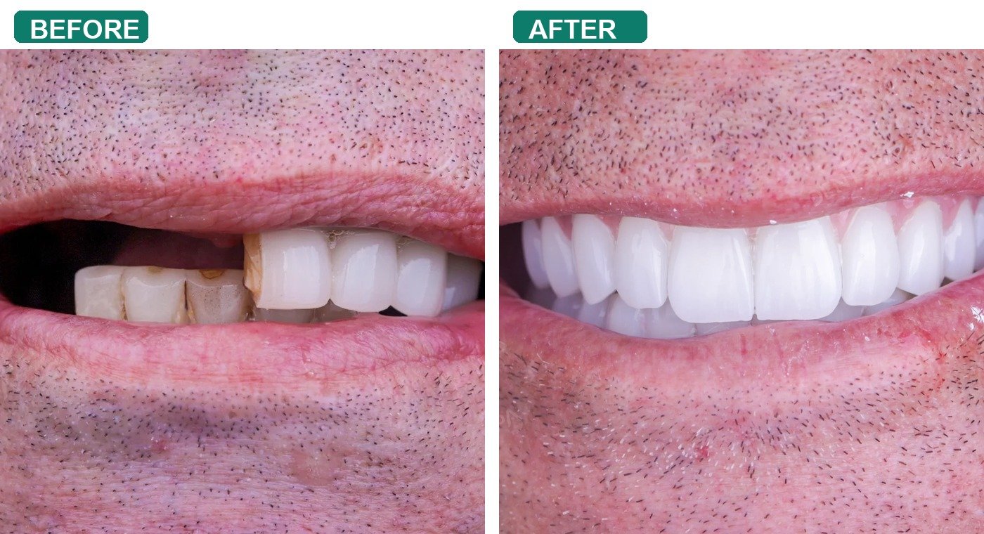 Before After 1