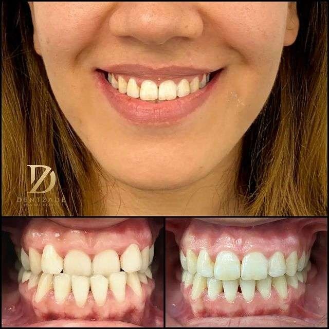 Before After 1