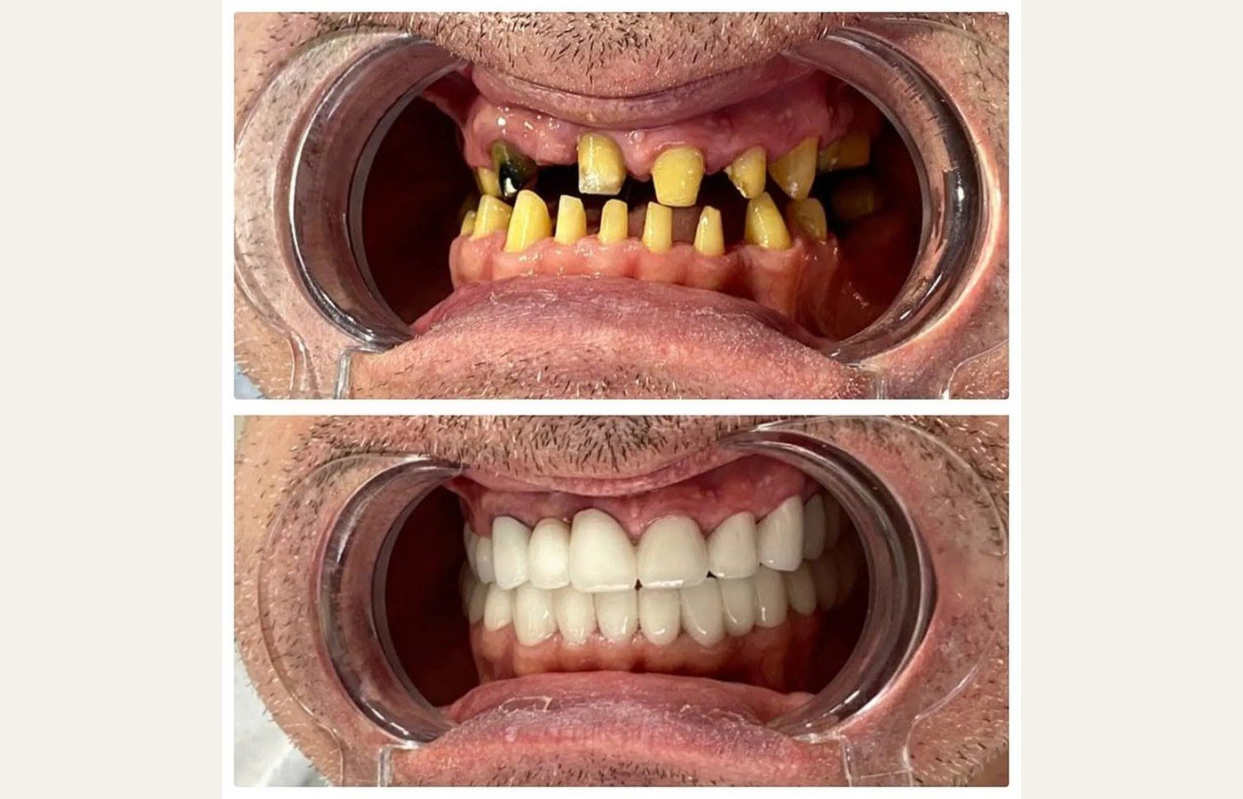 Before After 1
