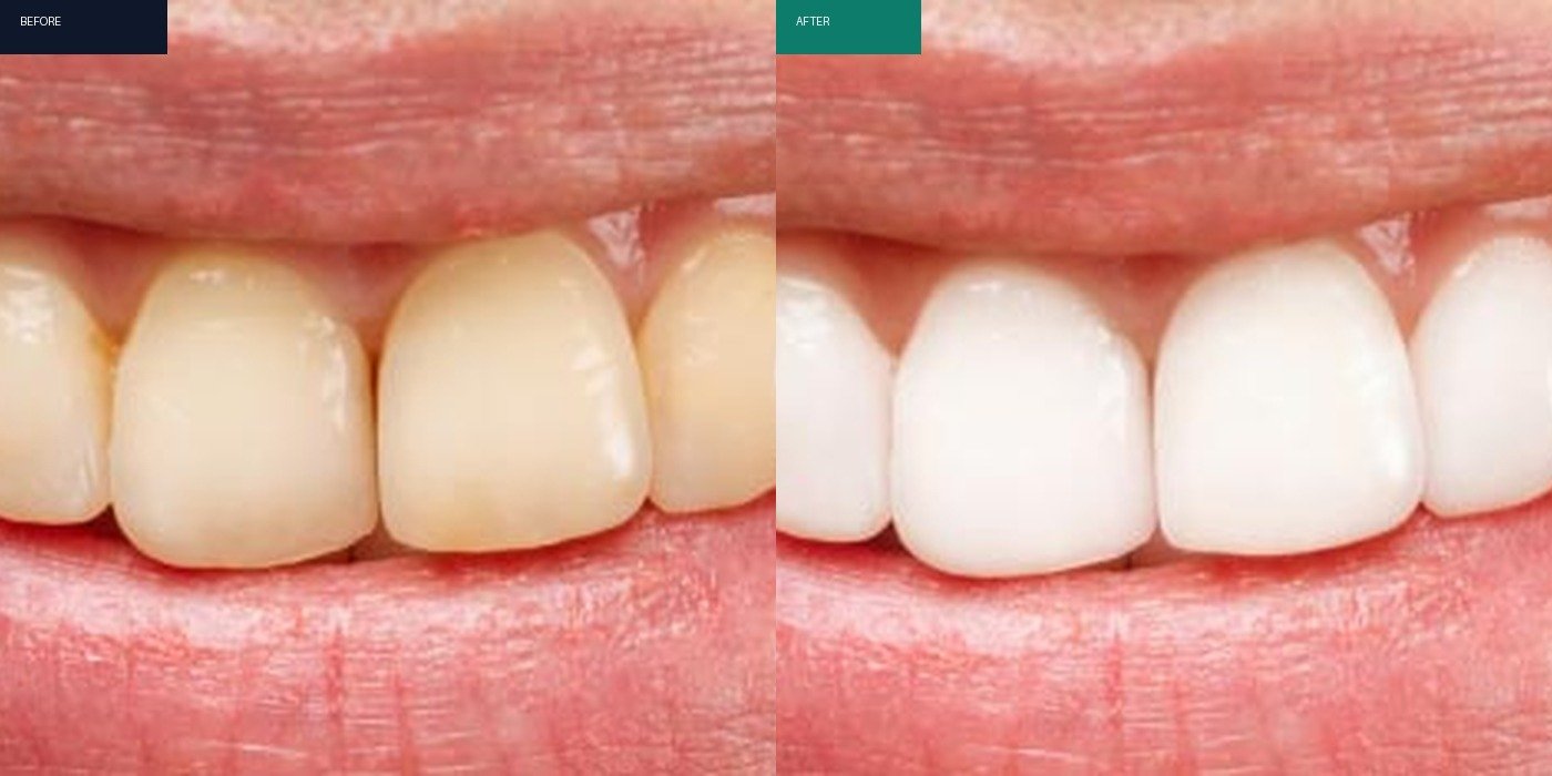 Before After 1