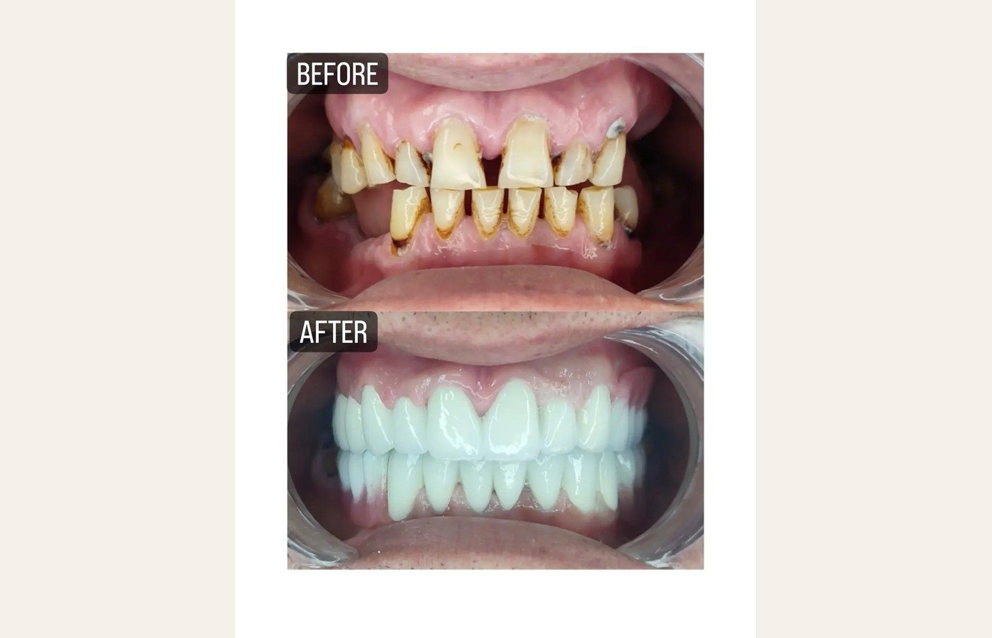 Before After 1