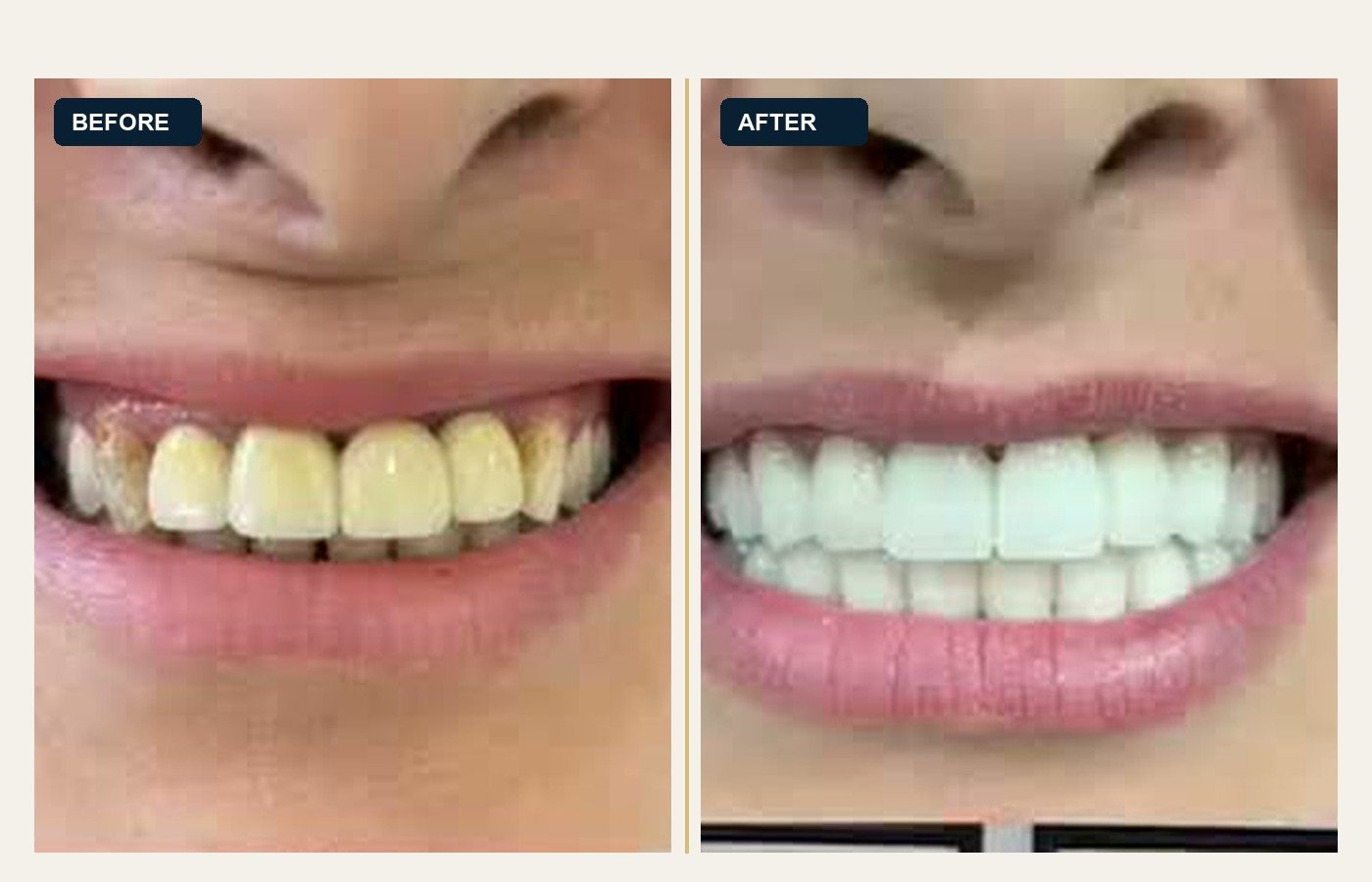 Before After 1