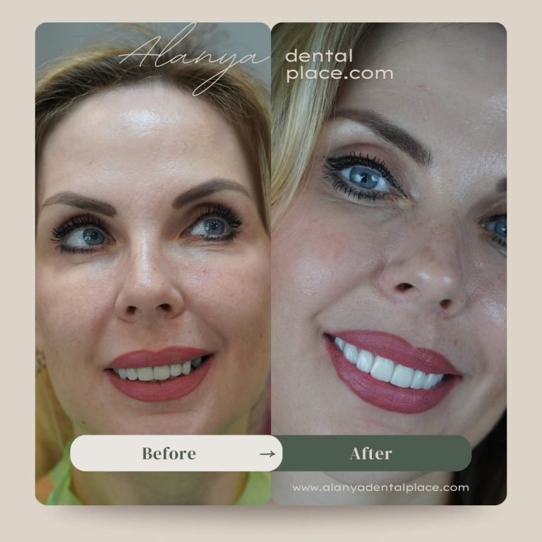 Before After 1