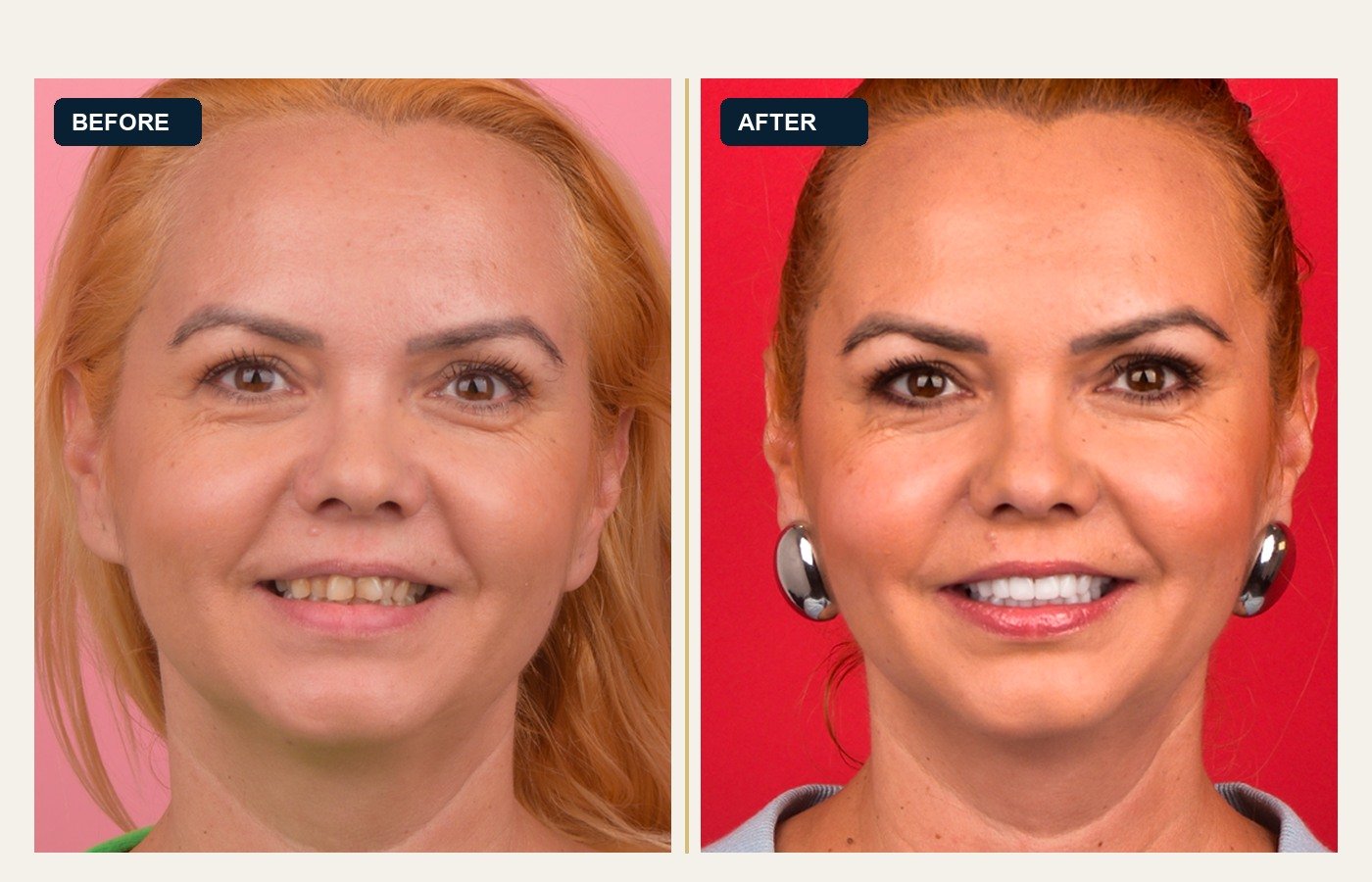 Before After 1