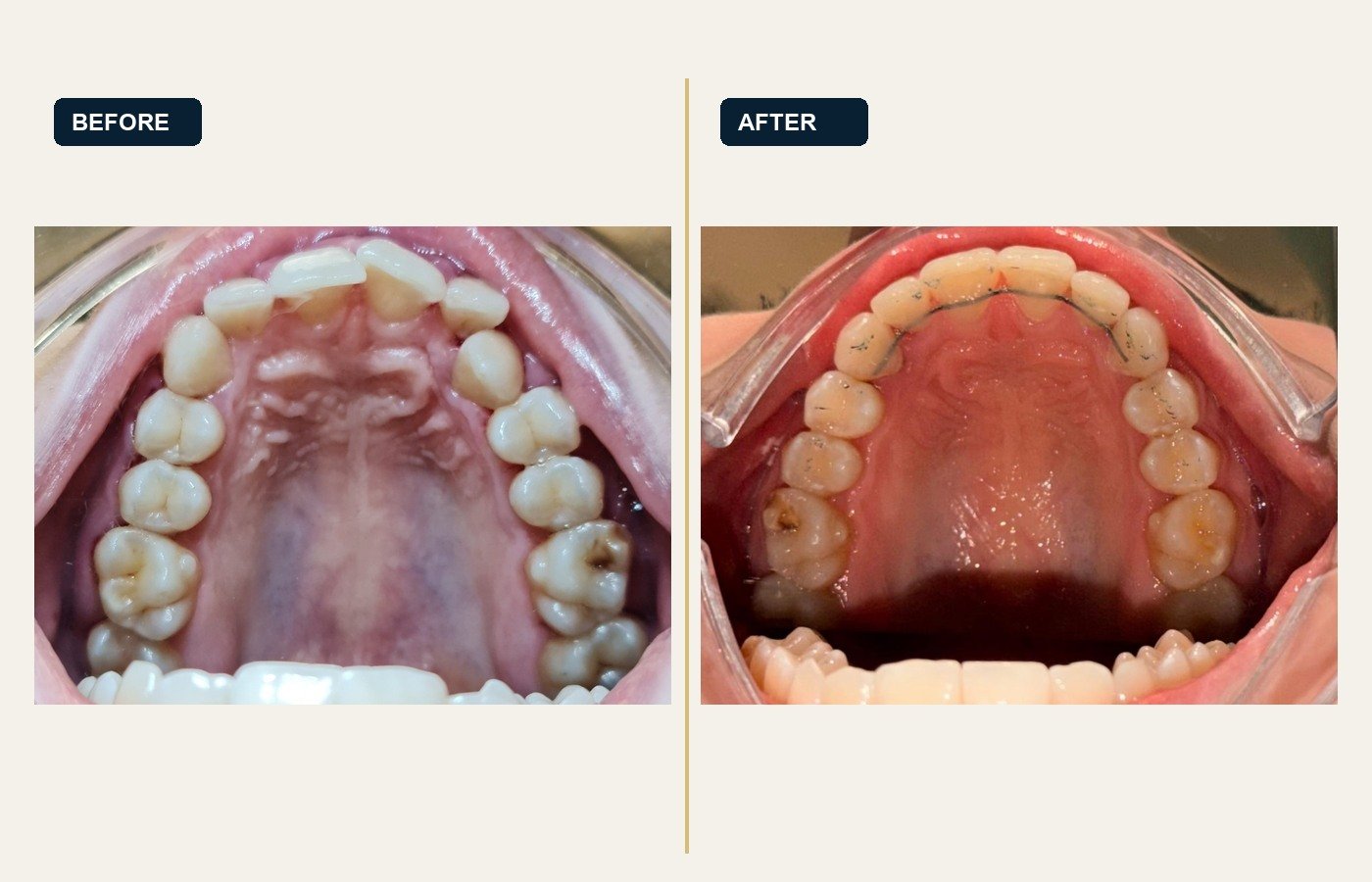 Before After 1