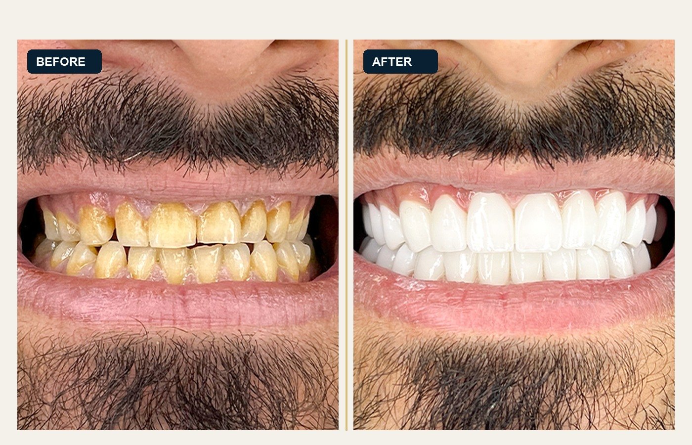 Before After 1