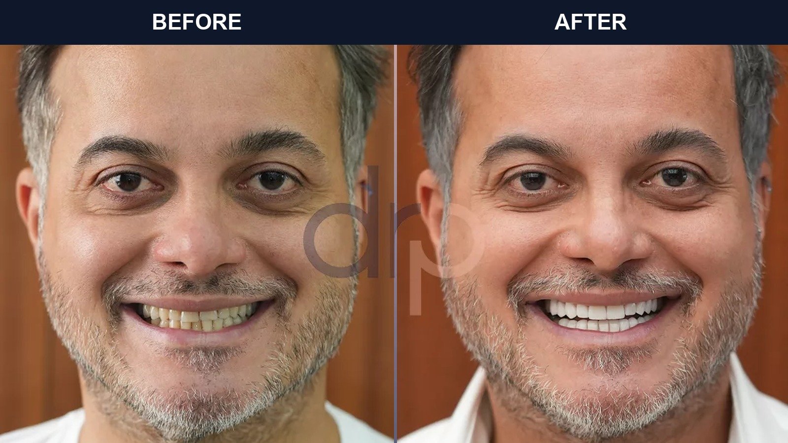 Before After 1