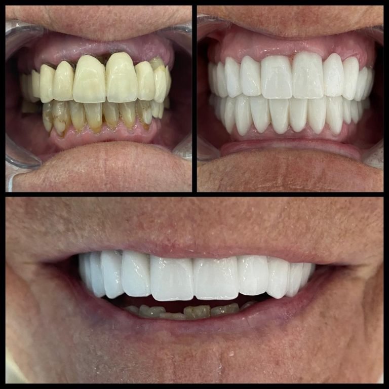 Before After 1