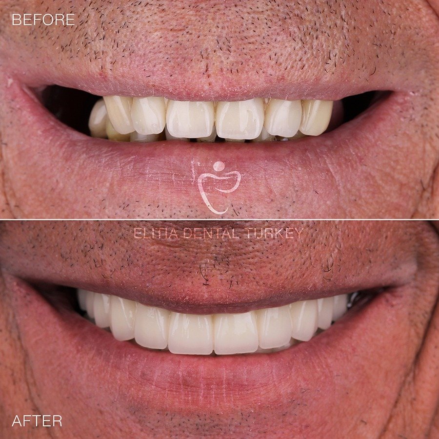 Before After 1