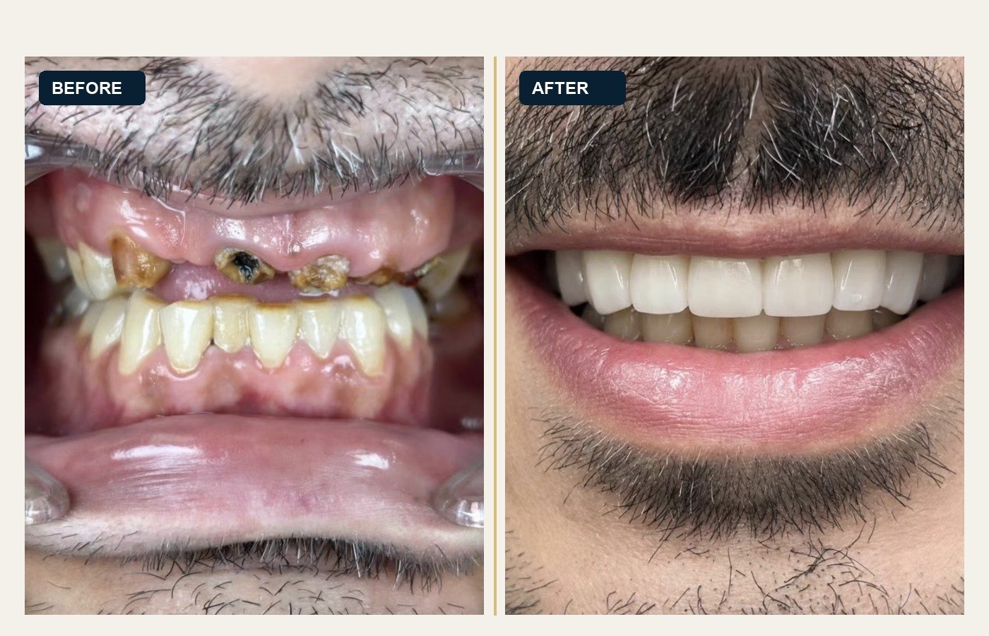 Before After 1