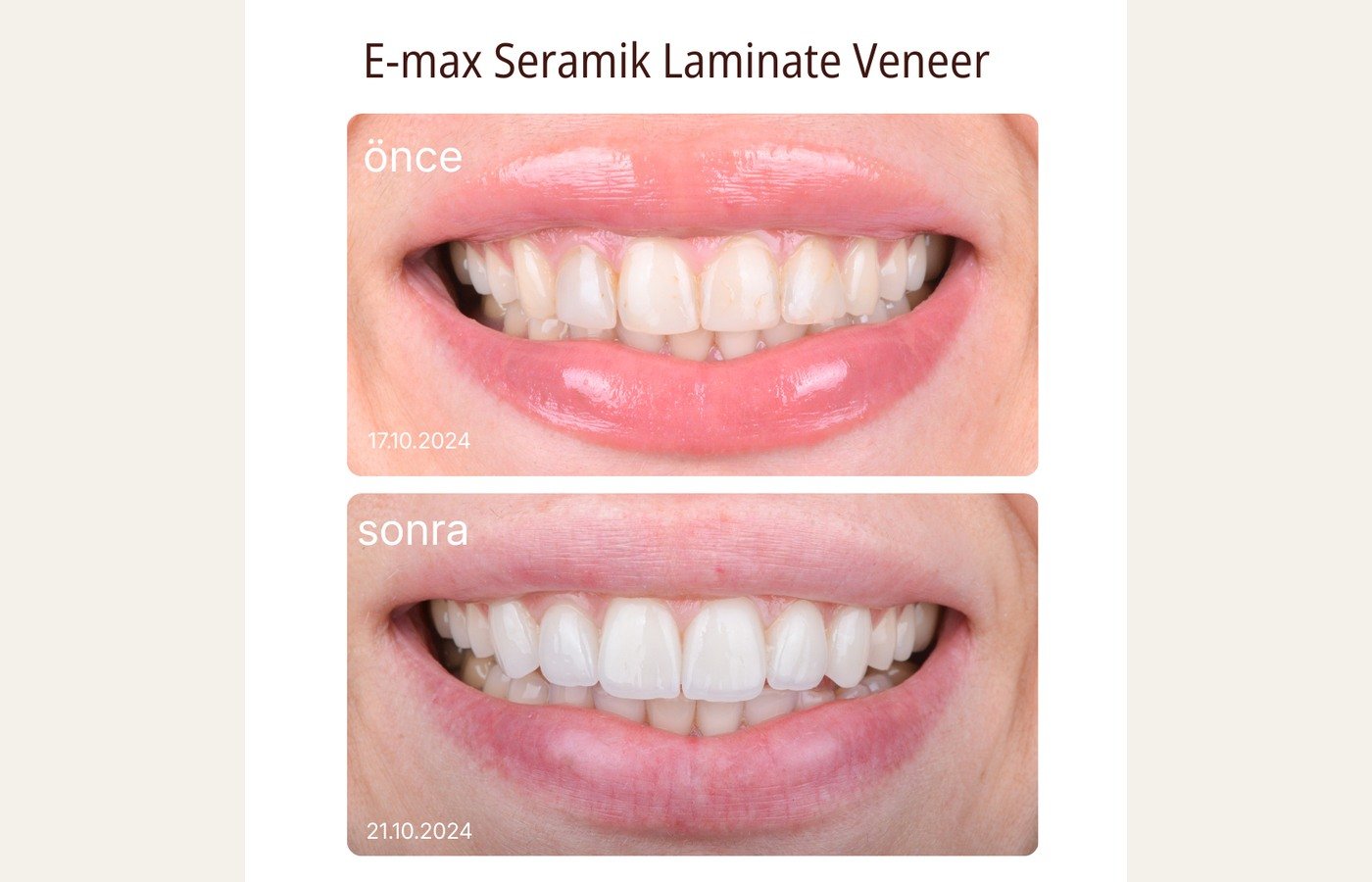 Before After 1