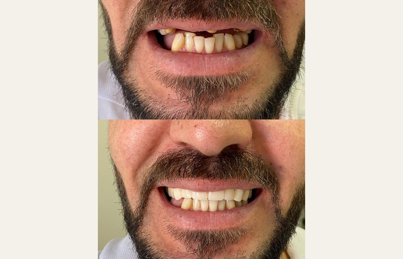 Before After 1