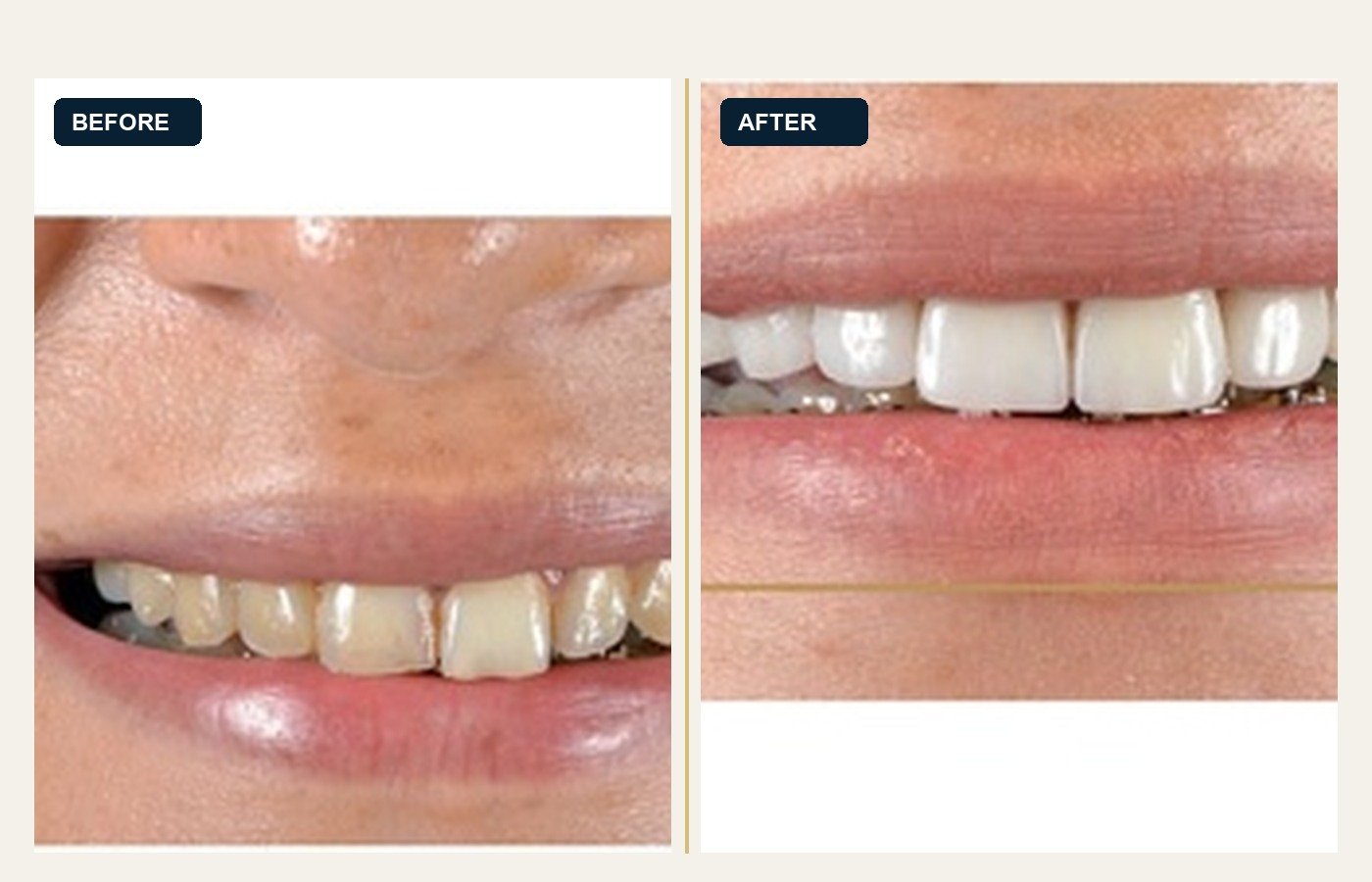 Before After 1