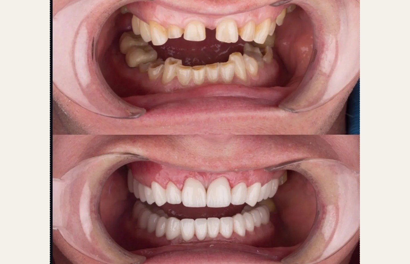 Before After 1