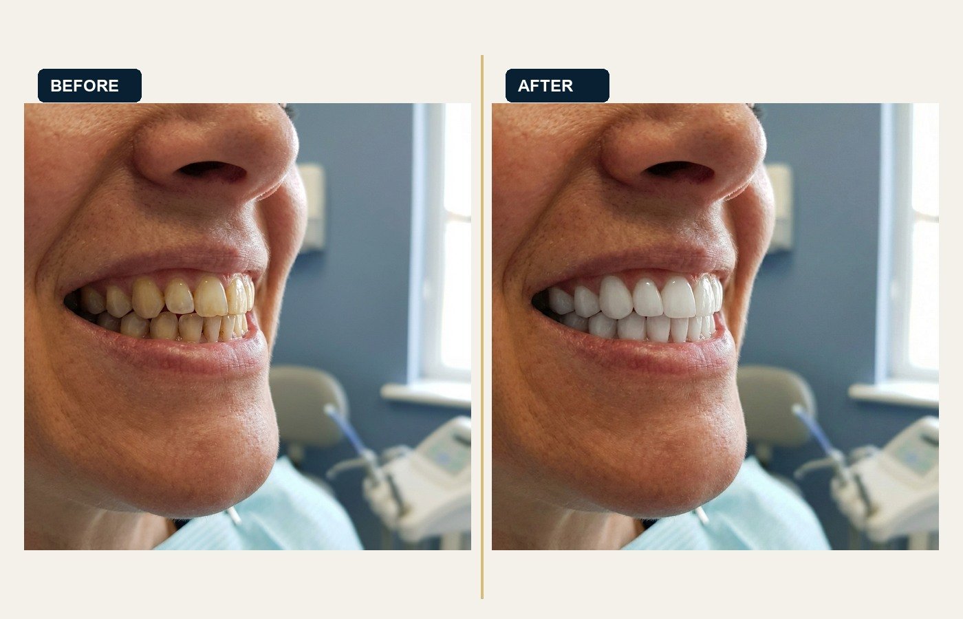 Before After 1