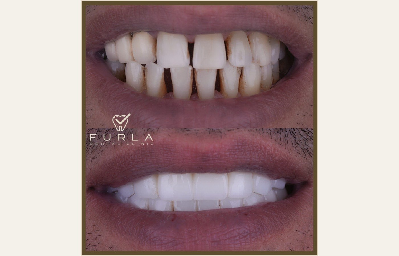 Before After 1