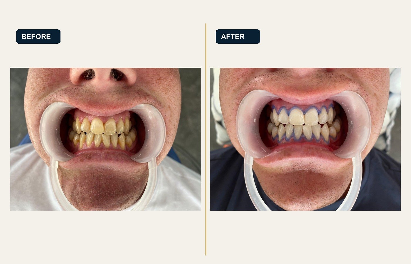 Before After 1