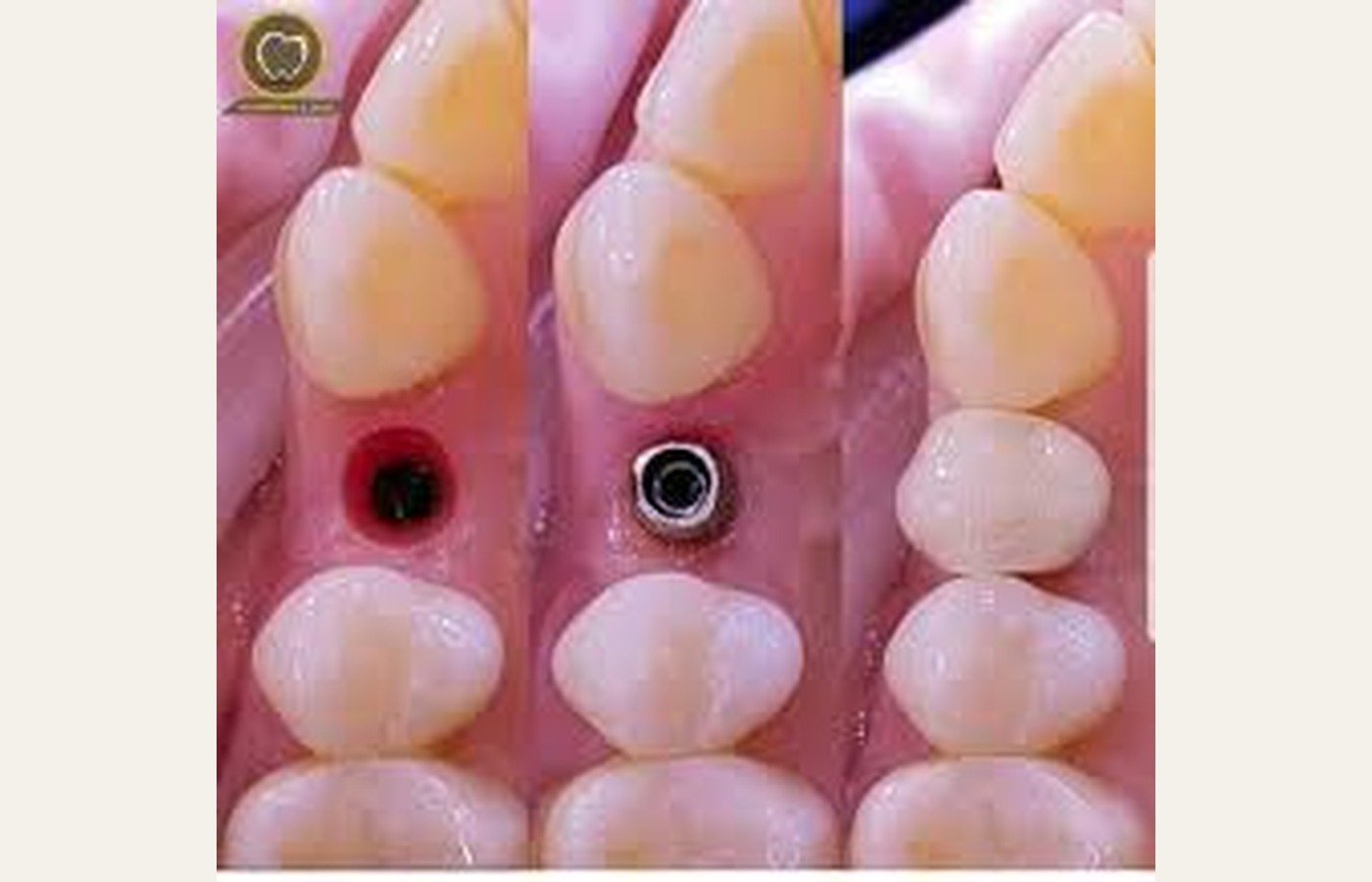 Before After 1
