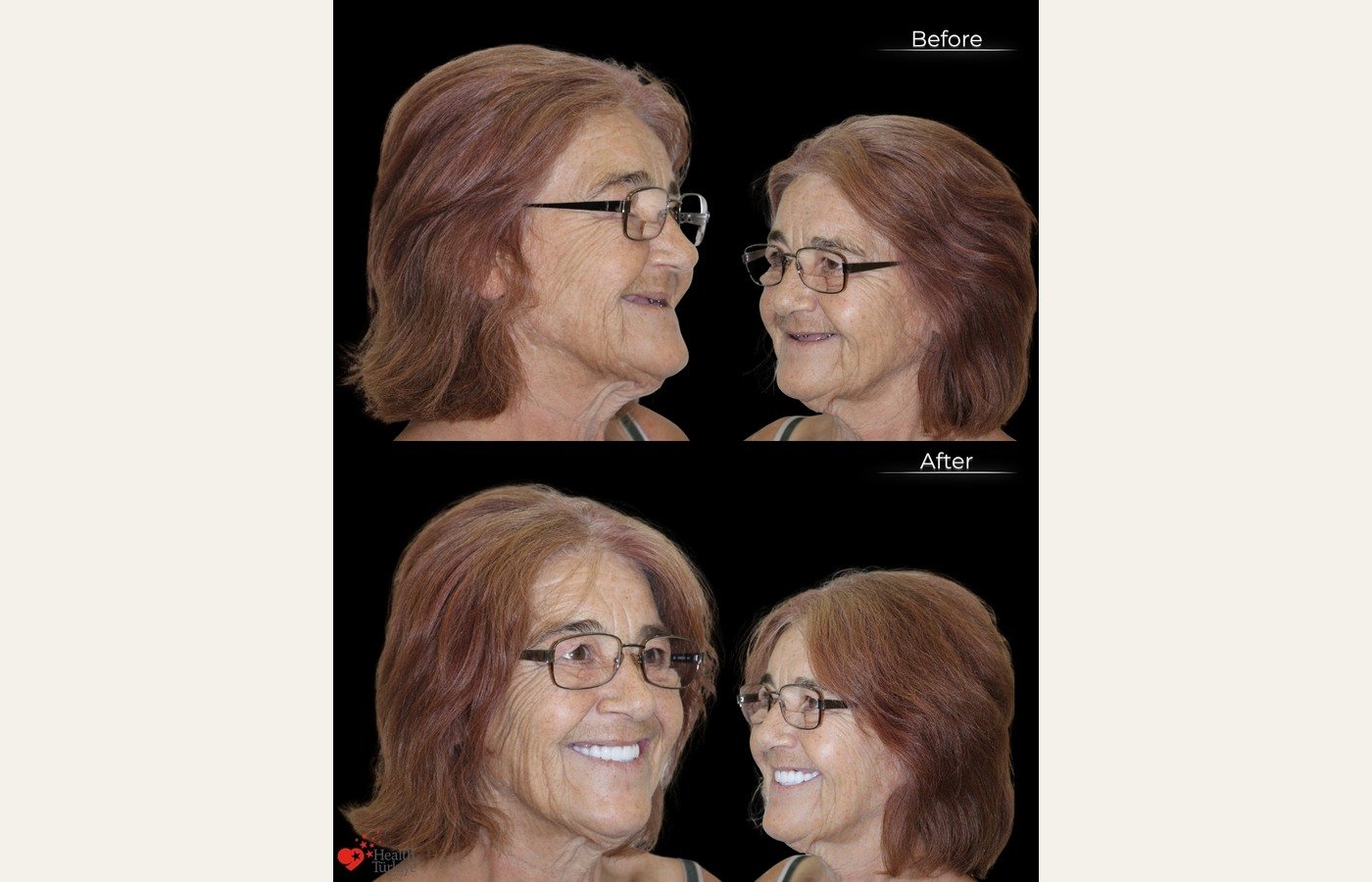 Before After 1