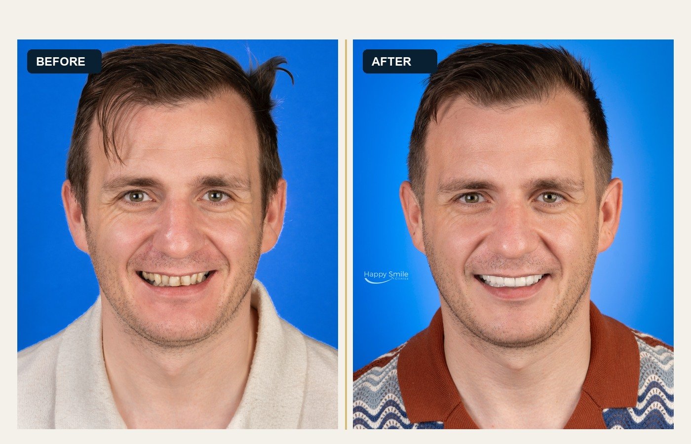 Before After 1