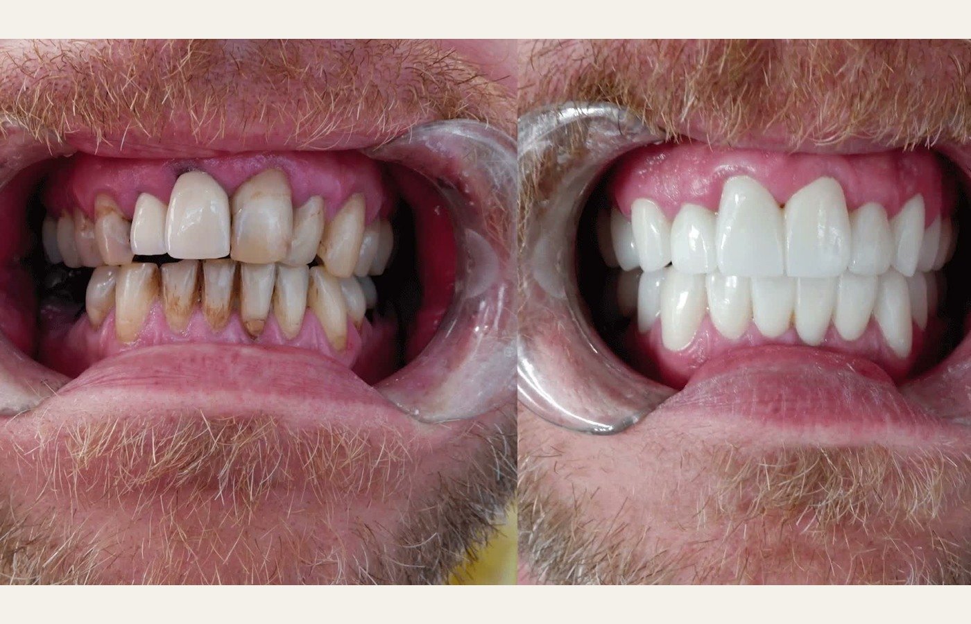 Before After 1