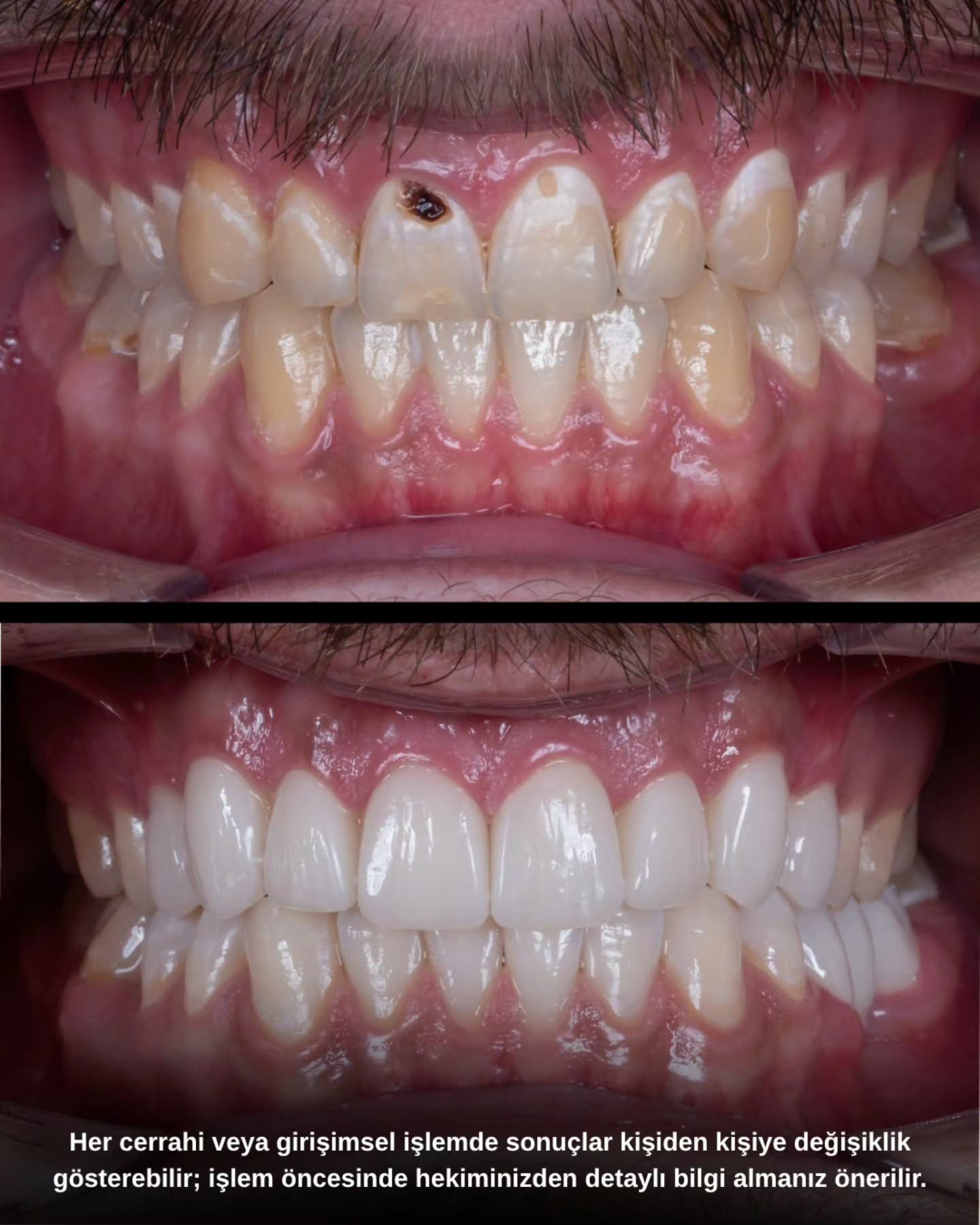 Before After 1