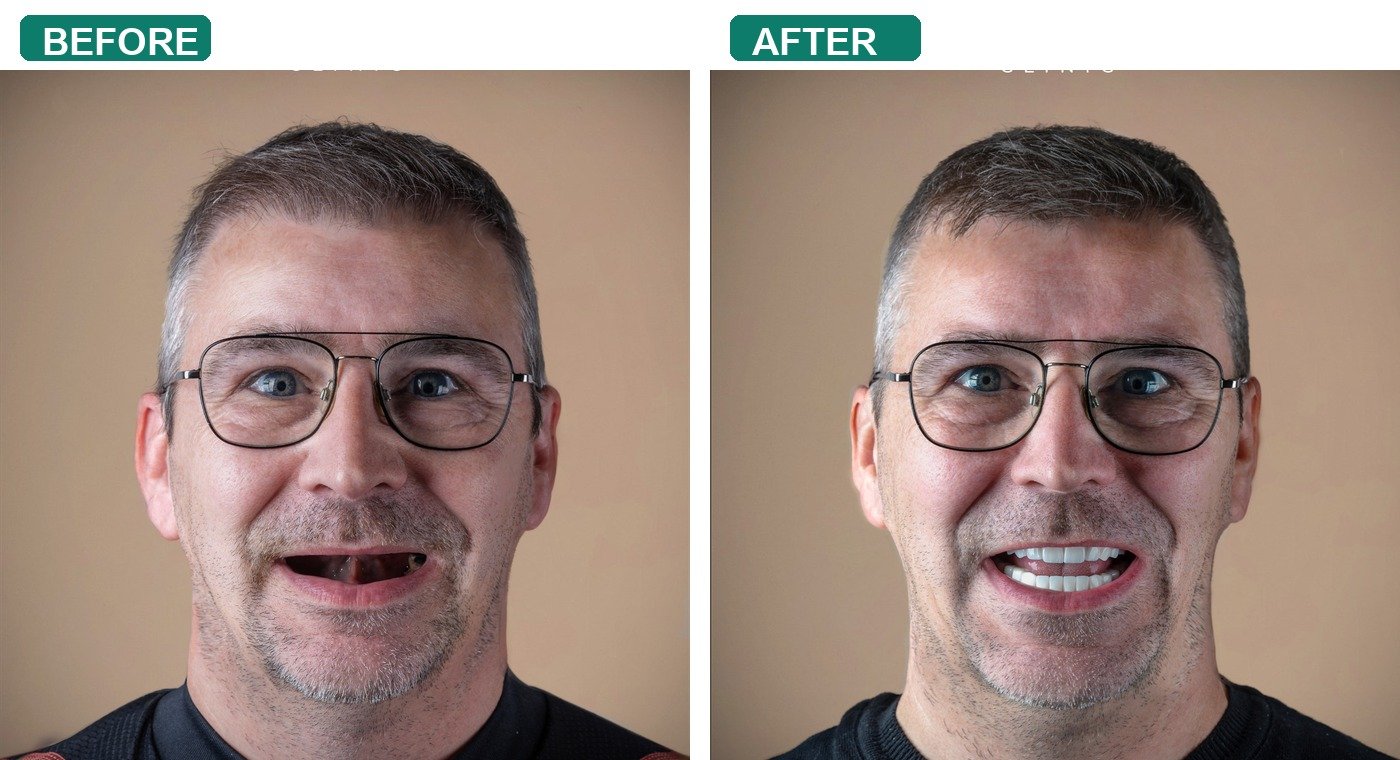 Before After 1