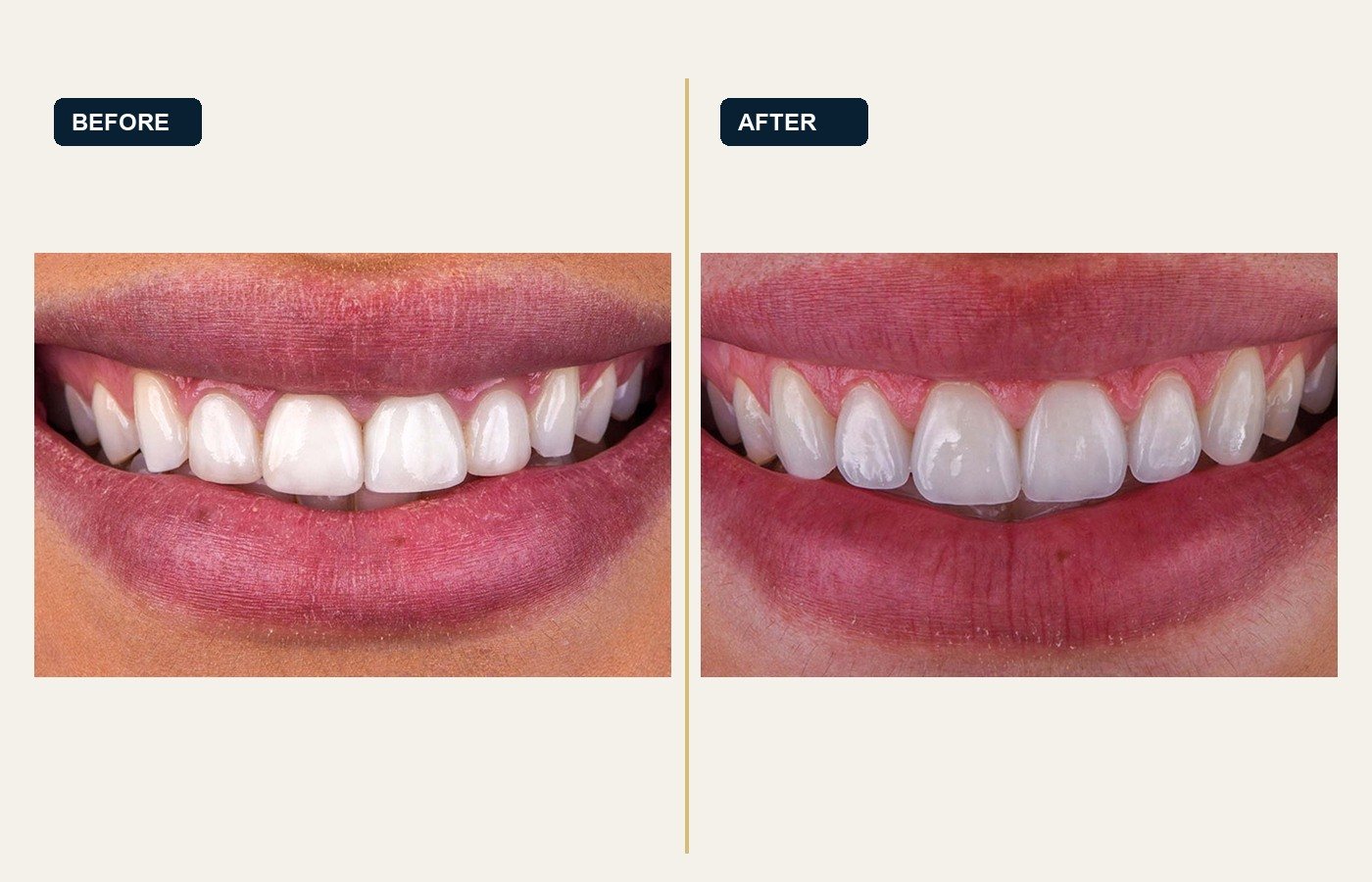 Before After 1