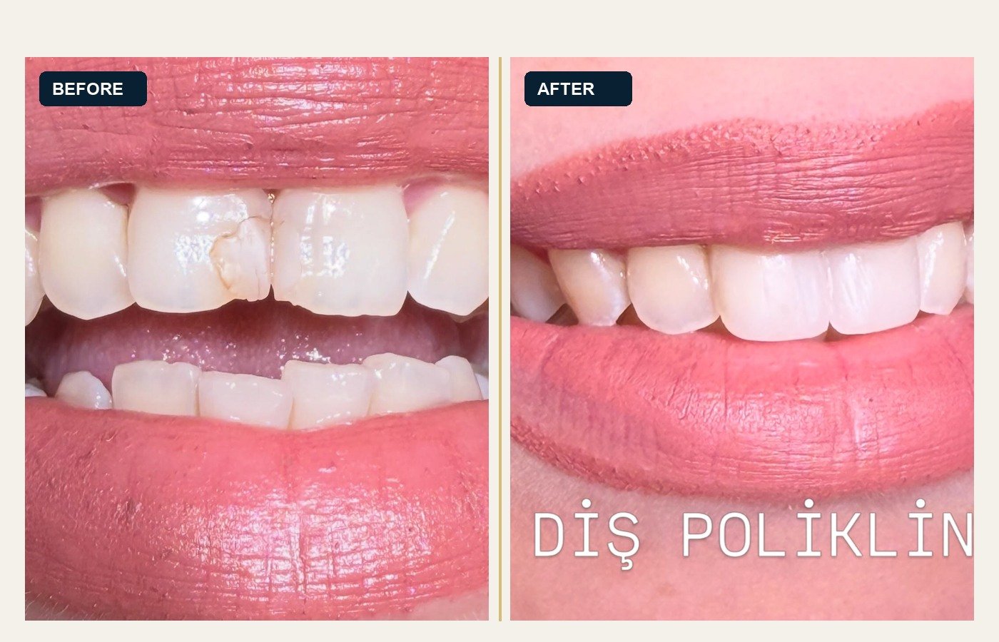 Before After 1