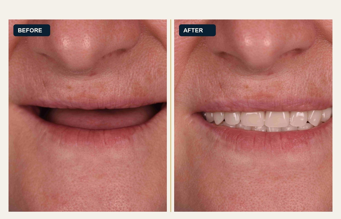 Before After 1