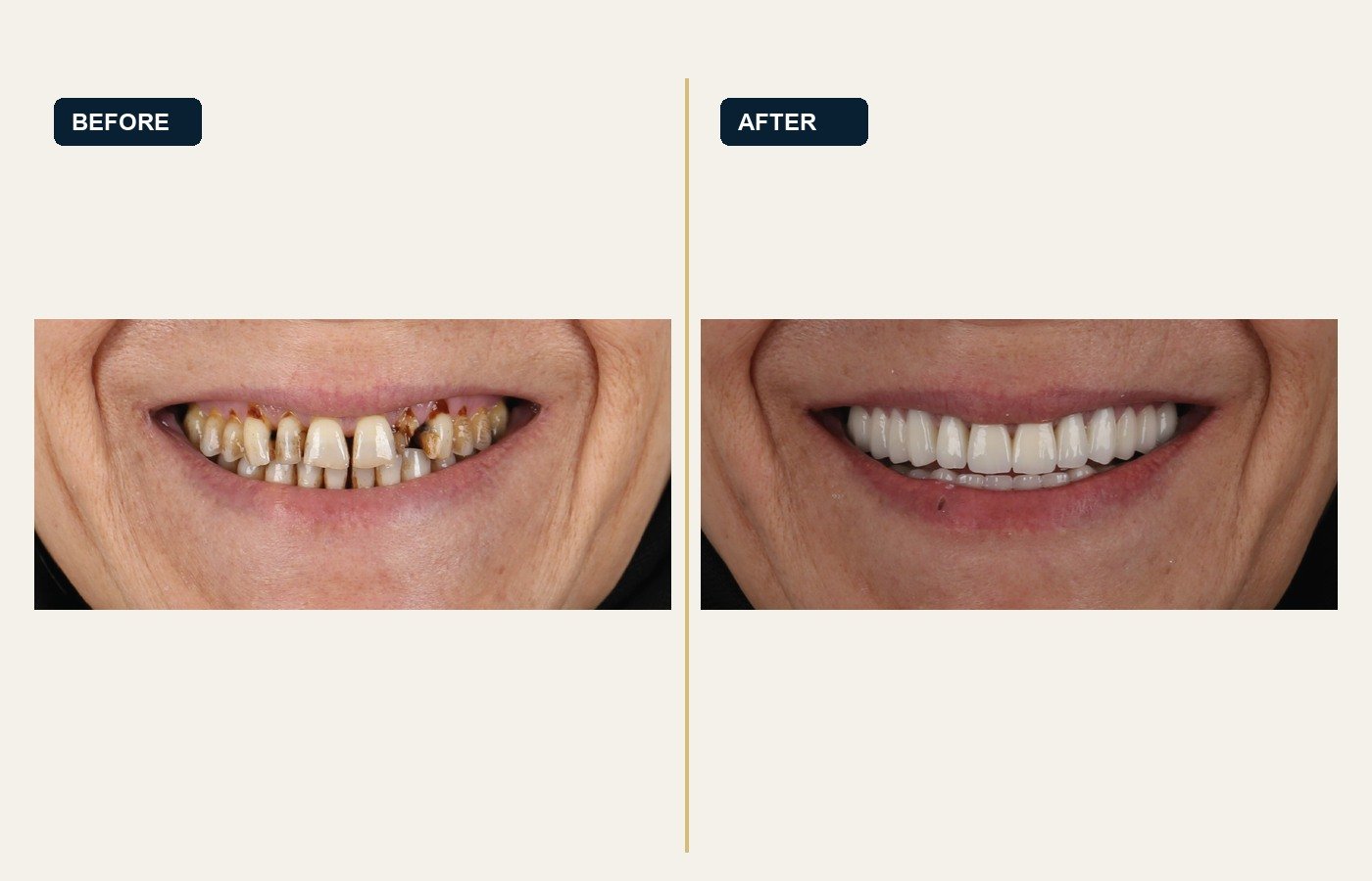 Before After 1