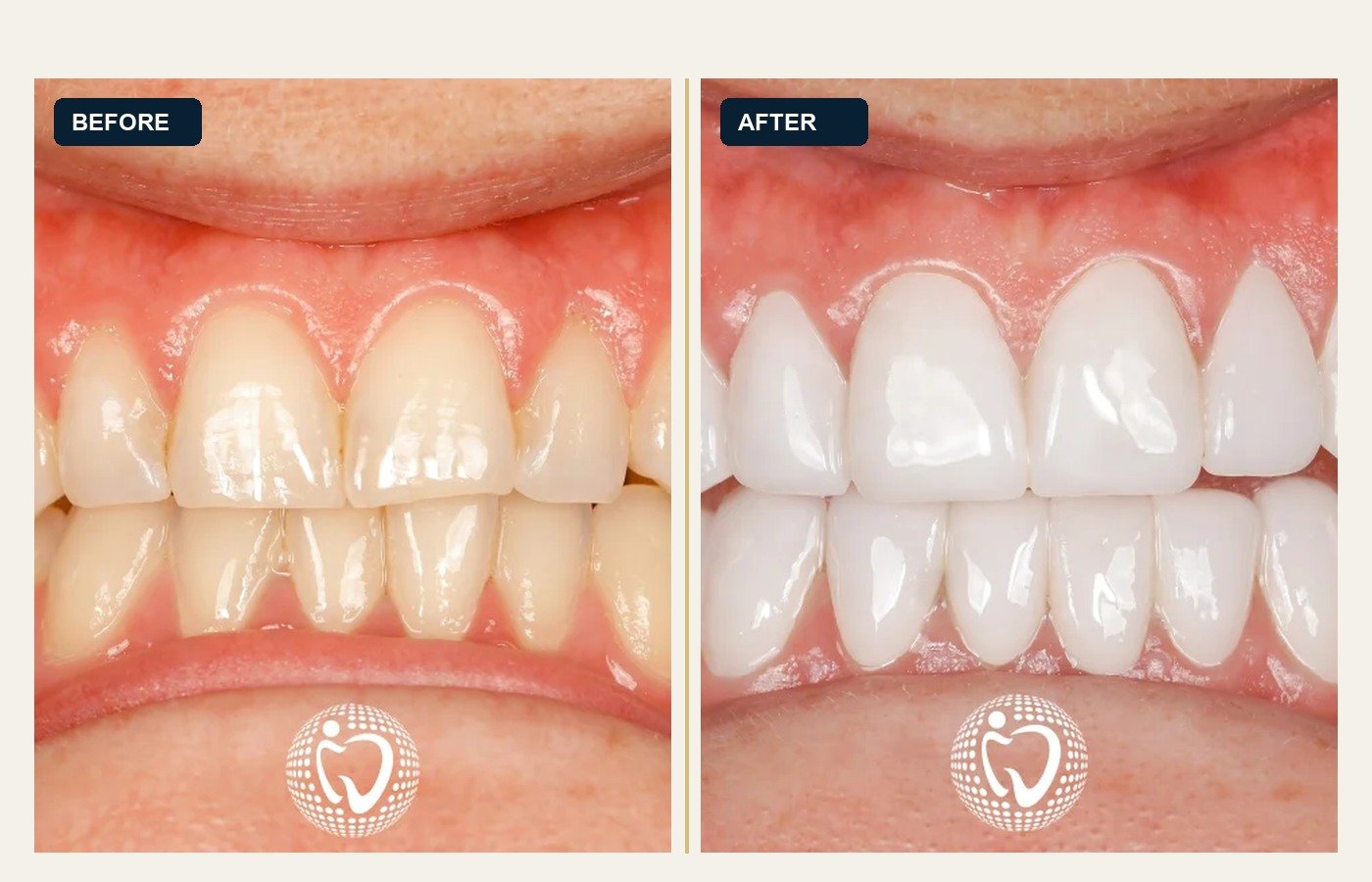 Before After 1