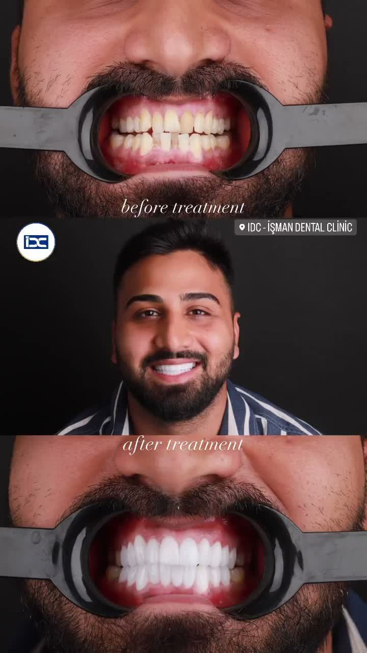 Before After 1