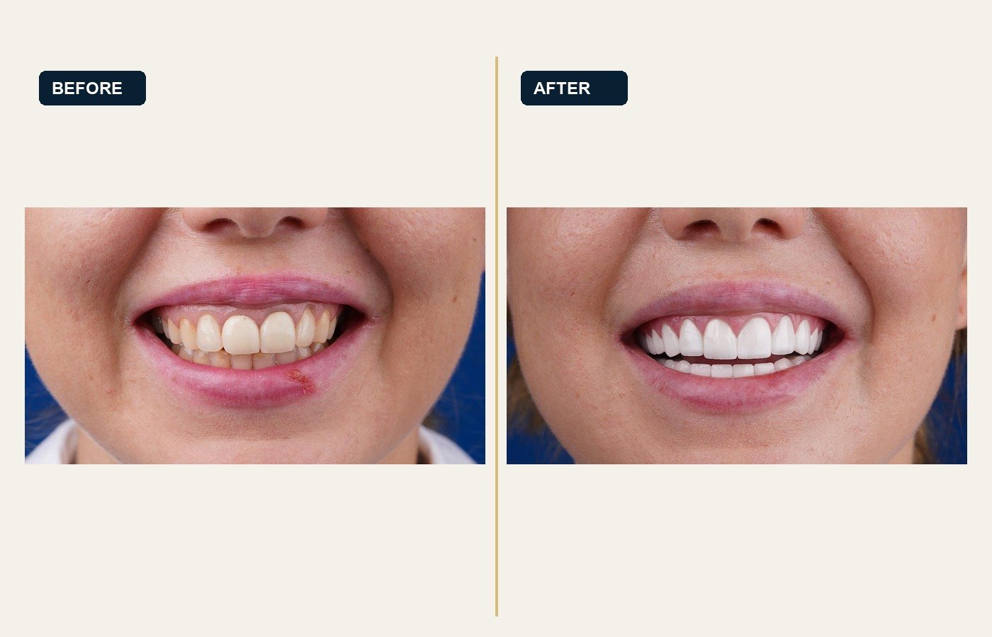 Before After 1