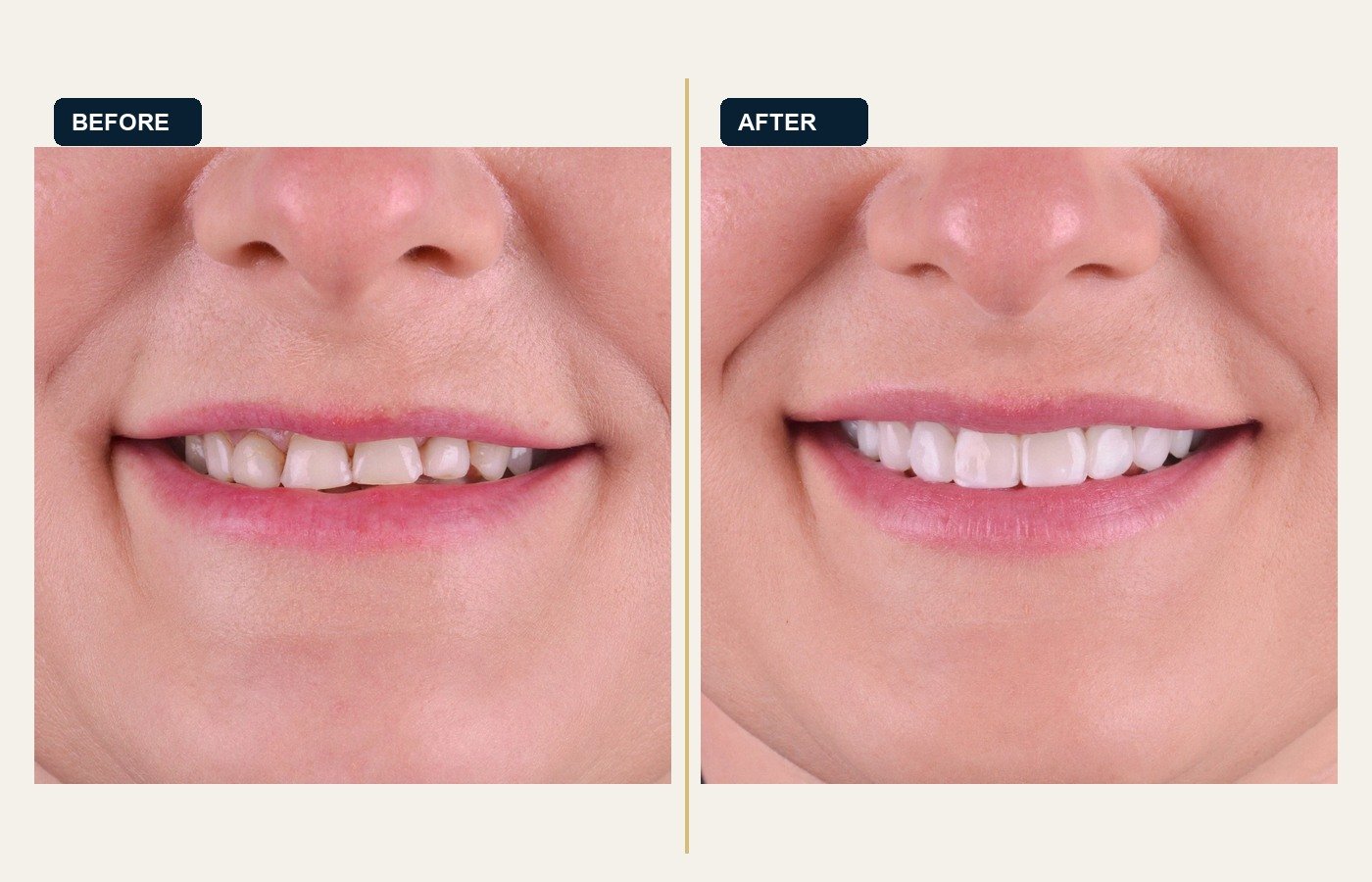 Before After 1