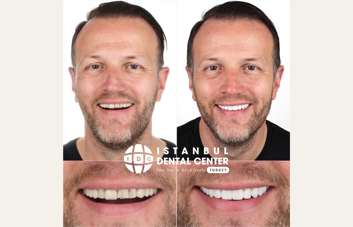 Before After 1