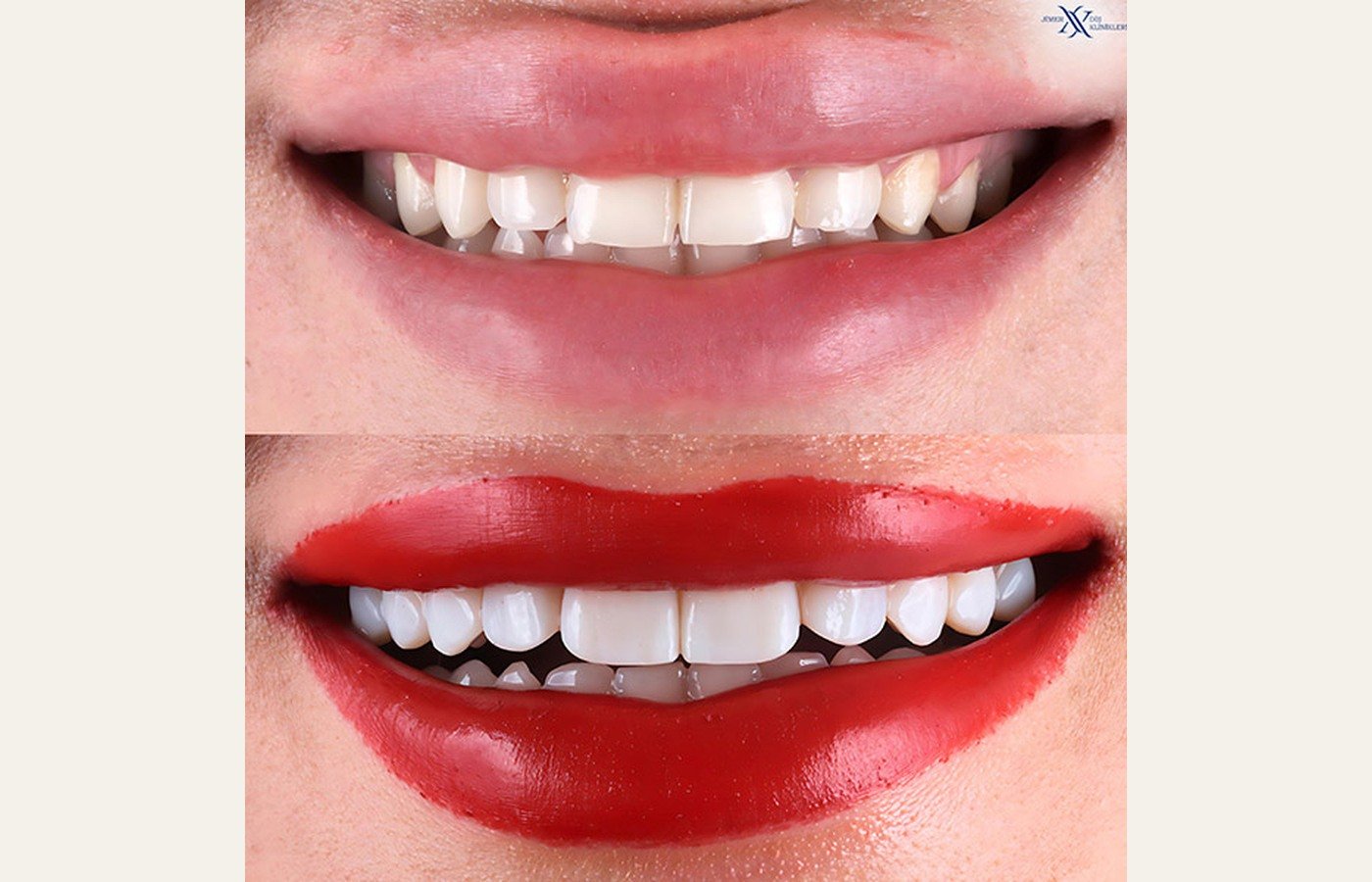 Before After 1