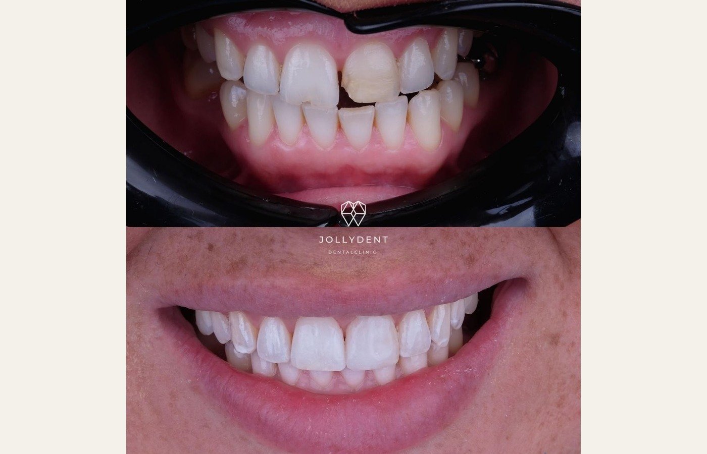 Before After 1