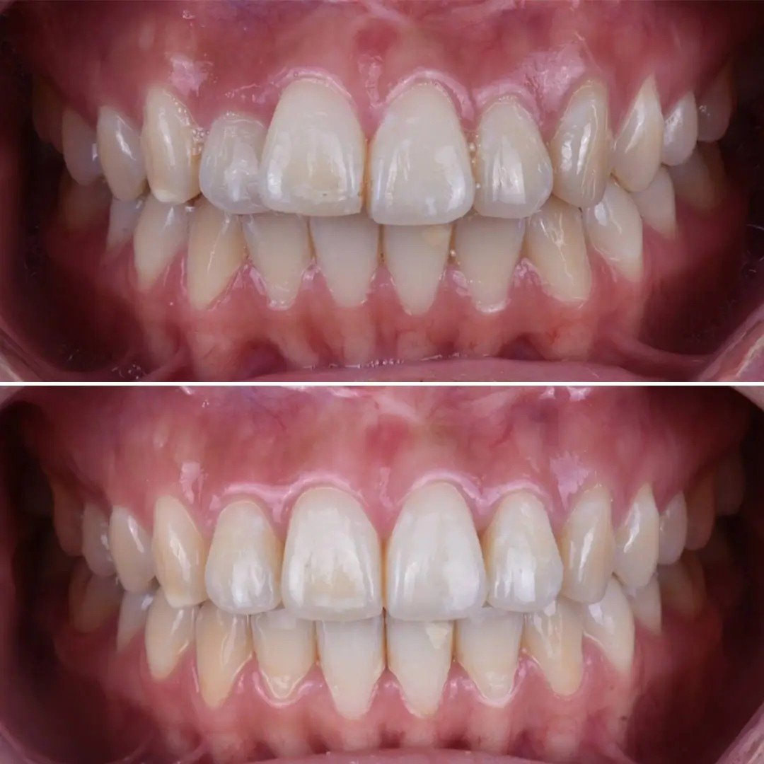 Before After 1