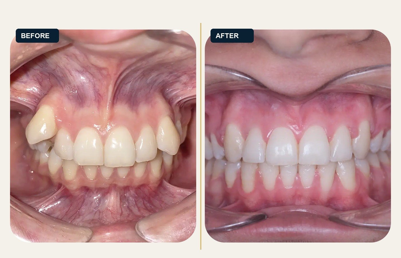 Before After 1