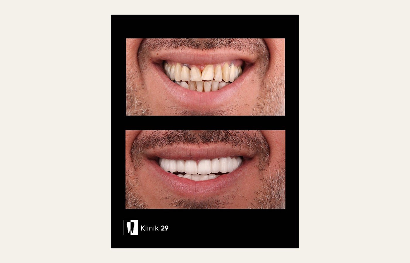 Before After 1