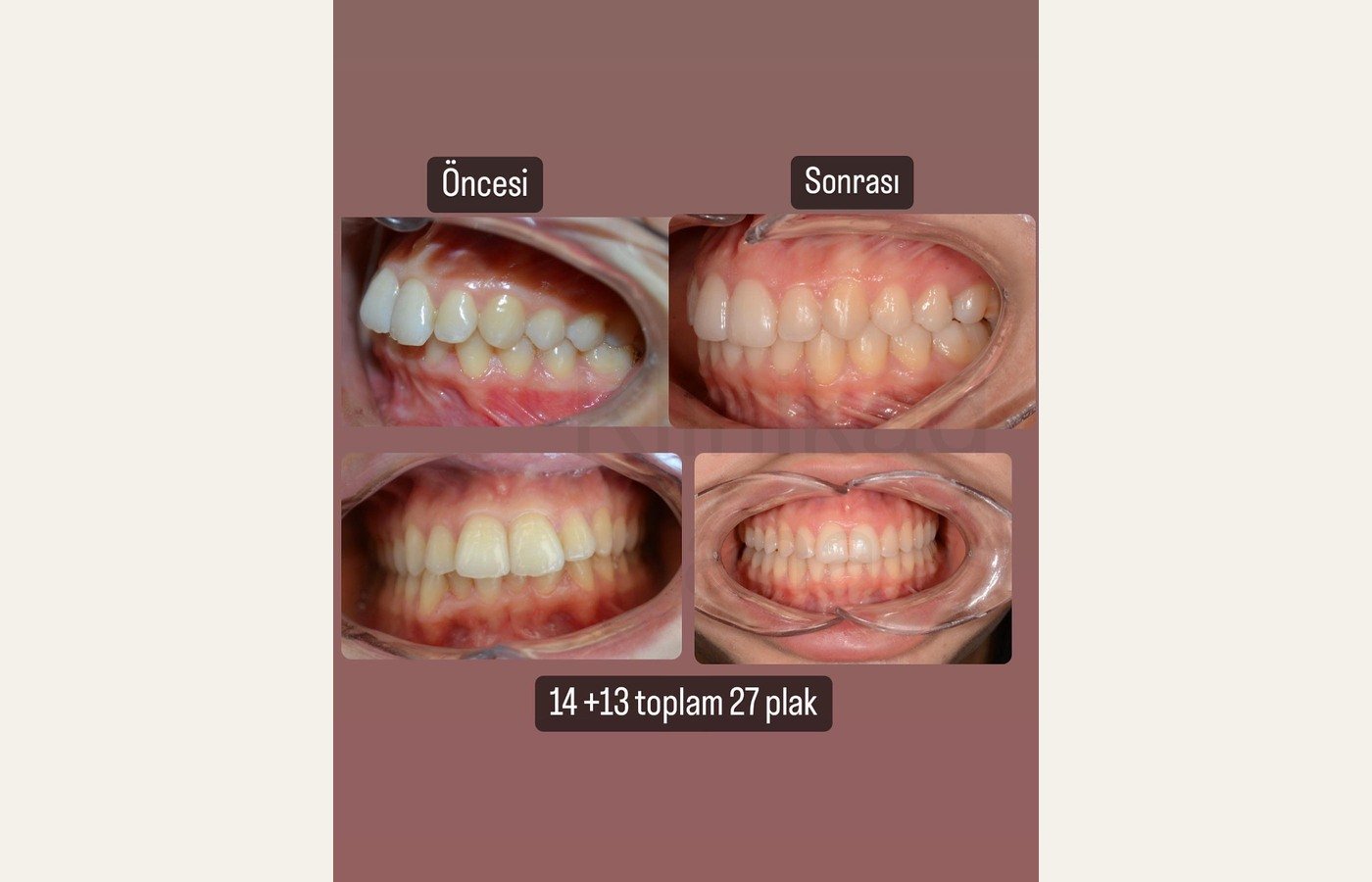Before After 1
