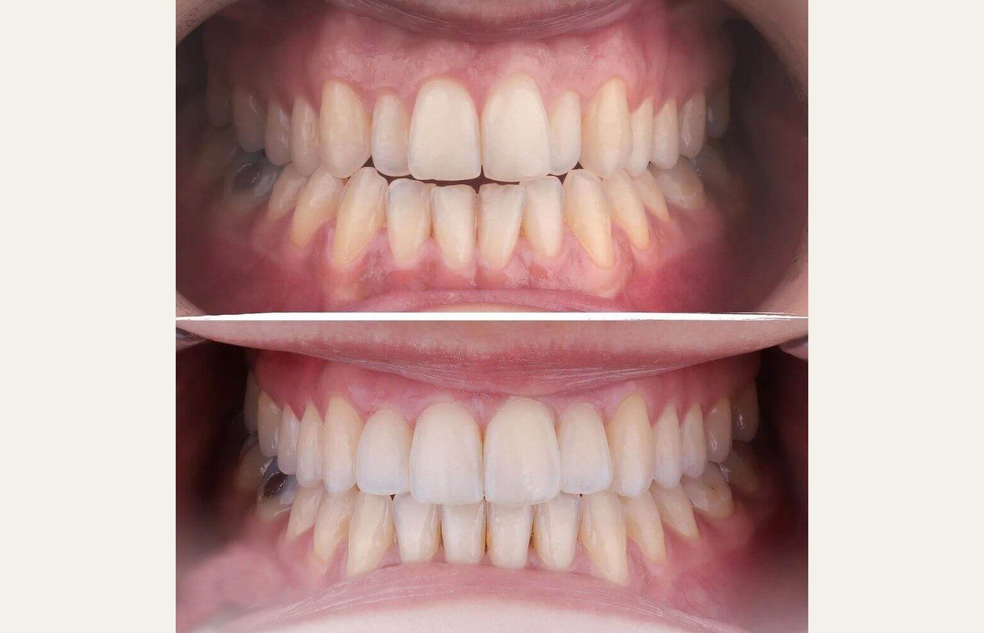 Before After 1