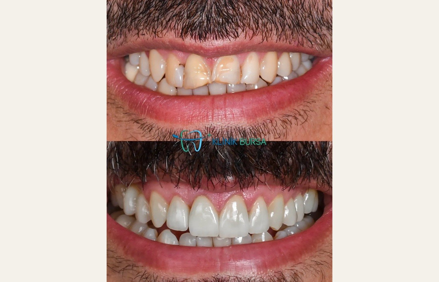 Before After 1