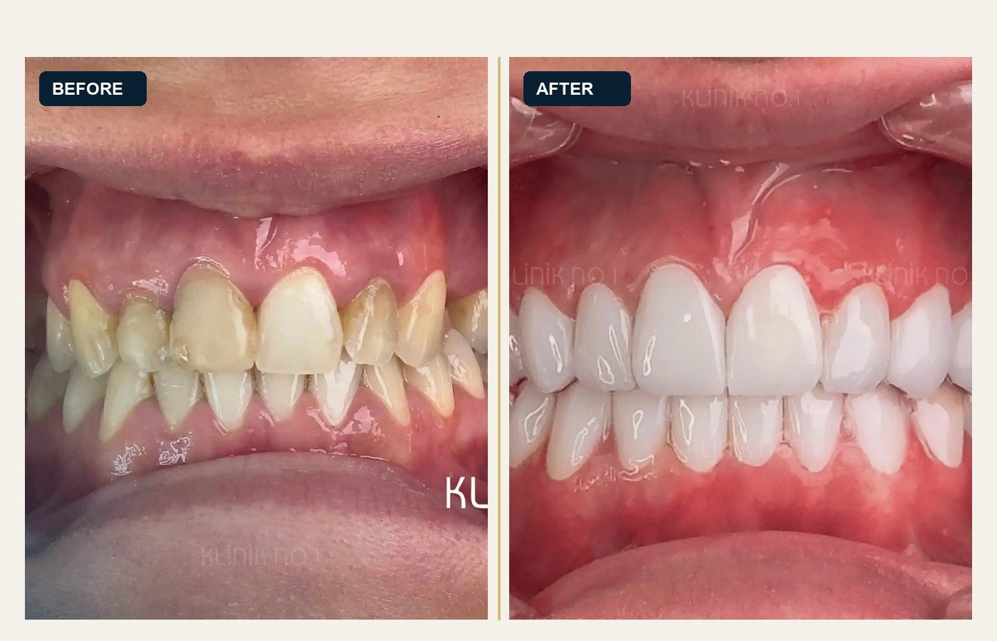 Before After 1