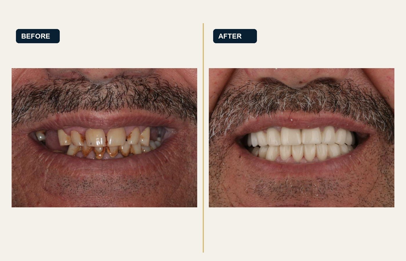 Before After 1