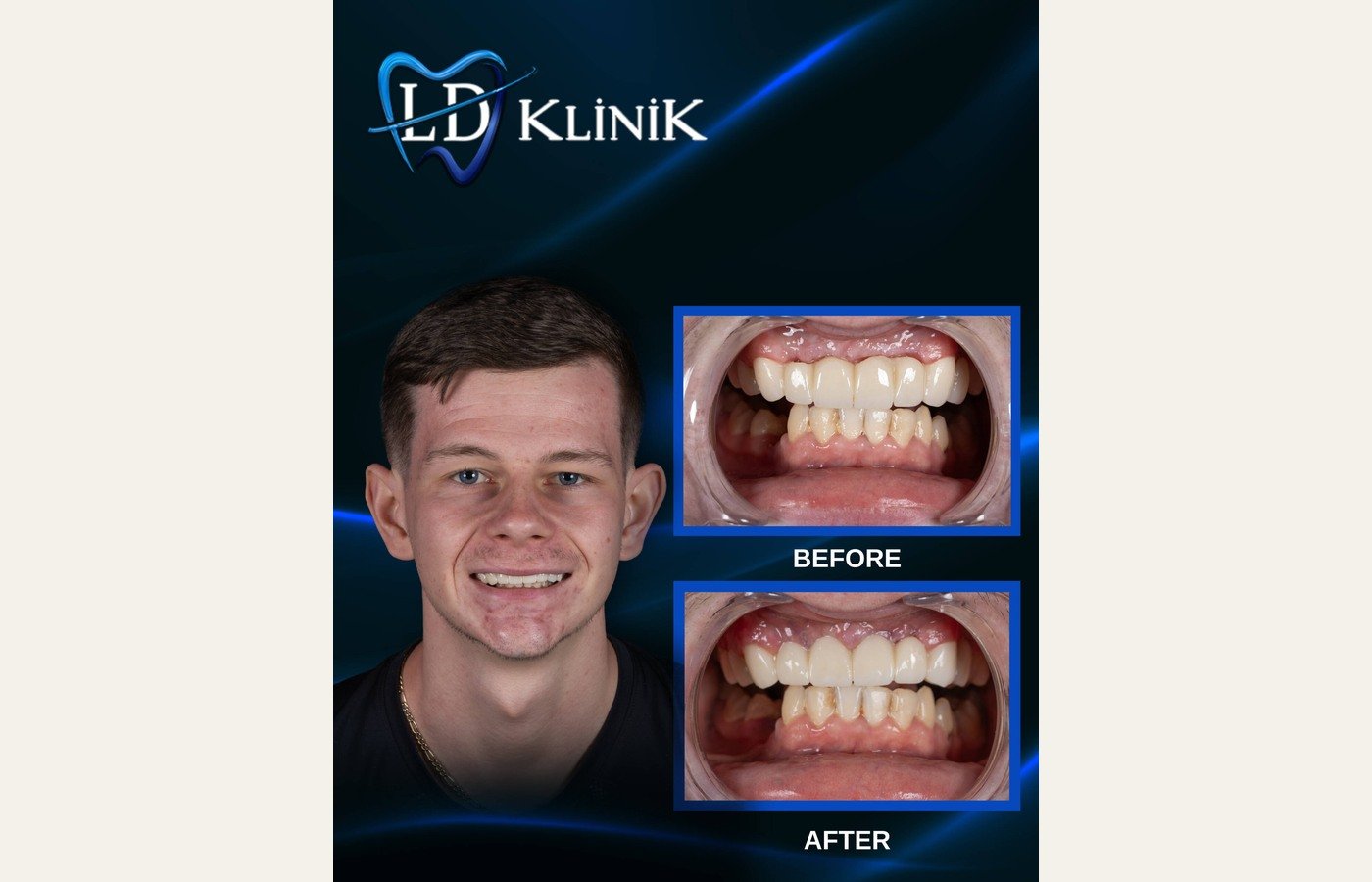 Before After 1