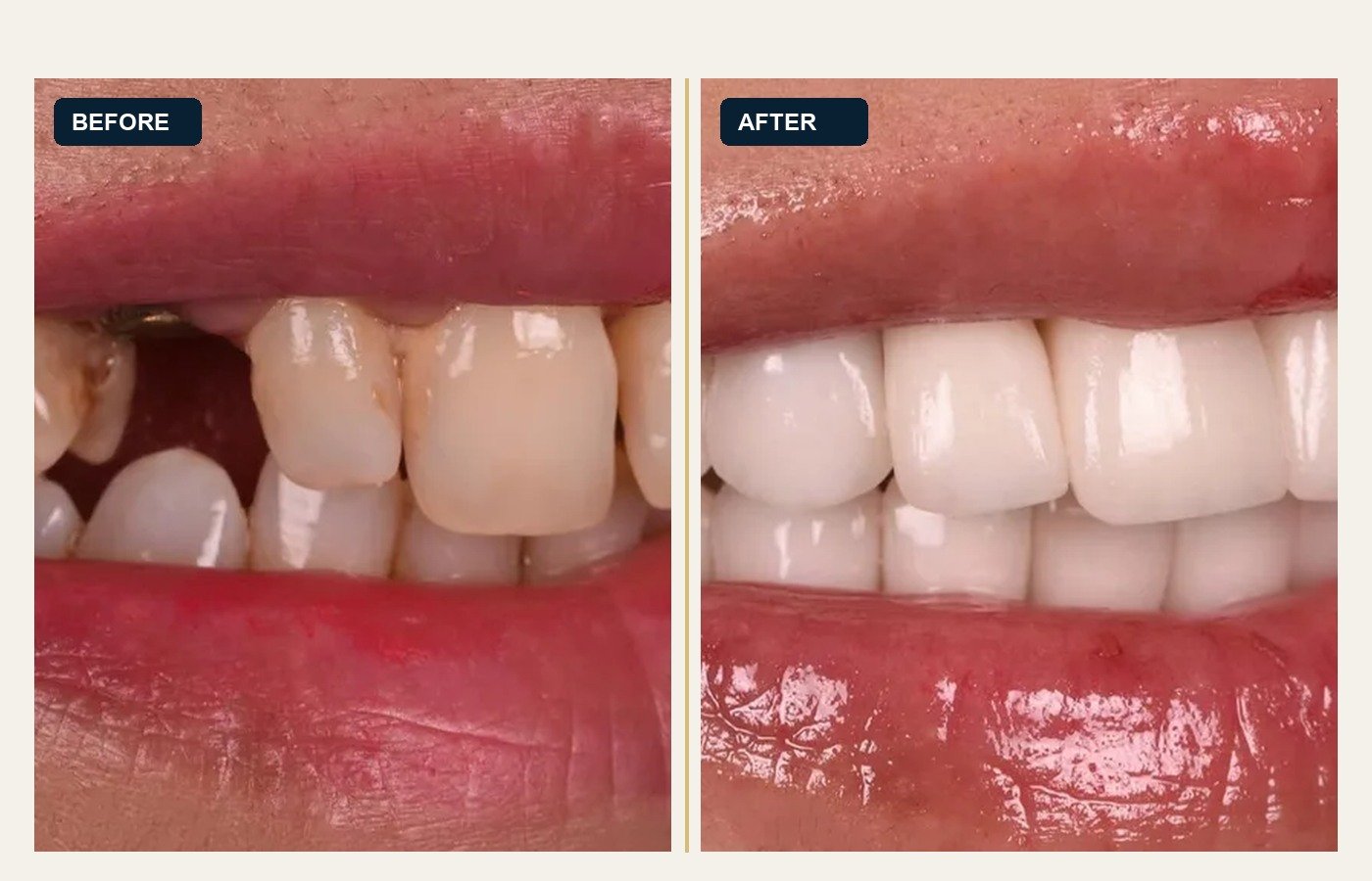 Before After 1