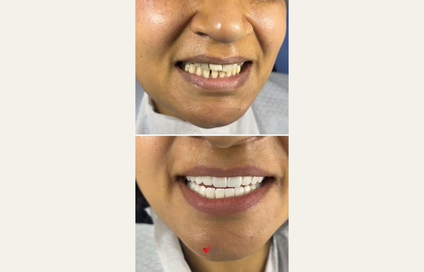 Before After 1