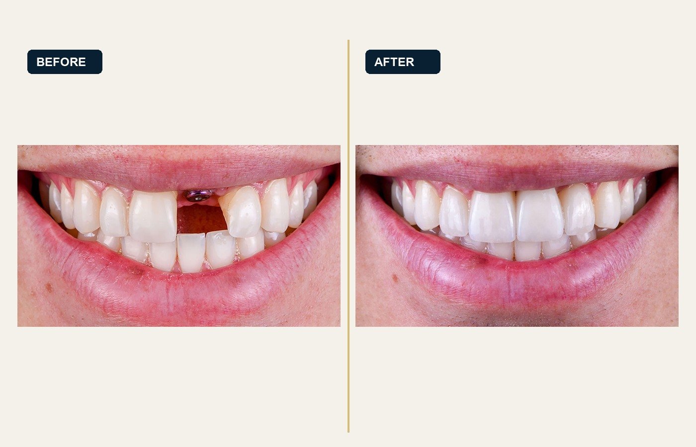 Before After 1